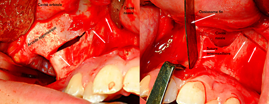 Decoupe-EPRAC_SARPE-orthodontiste-Chamberland-Quebec