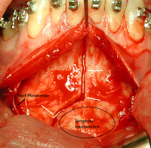 Decoupe-de-la-symphyse-orthodontiste-Chamberland-Quebec