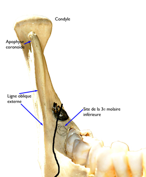 Decoupe-en-vue-frontale-osteotomie-mandibulaire-orthodontiste-Chamberland-Quebec
