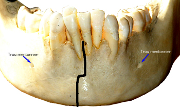Decoupe-frontale-distraction-de-la-symphyse-orthodontiste-Chamberland-Quebec