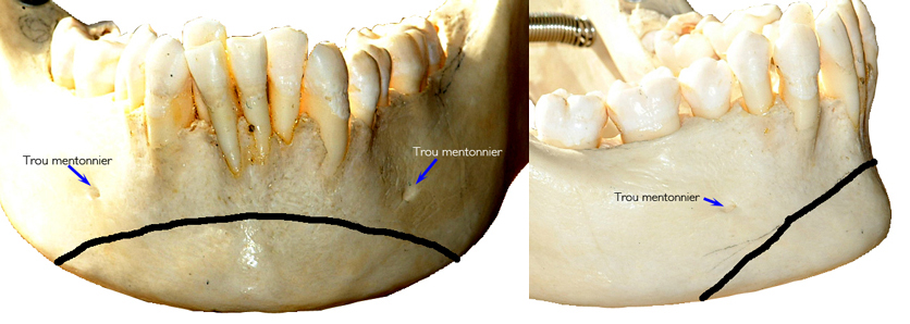 Decoupe-pour-genioplastie-Orthodontiste-Chamberland-Quebec