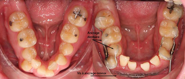 Distraction-de-la-symphyse-Md-orthodontiste-Chamberland-Quebec