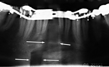 Fin-de-distraction-de-la-symphyse-orthodontiste-Chamberland-Quebec