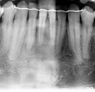Guerison-completee-de-distraction-symphyseale-orthodontiste-Chamberland-Quebec