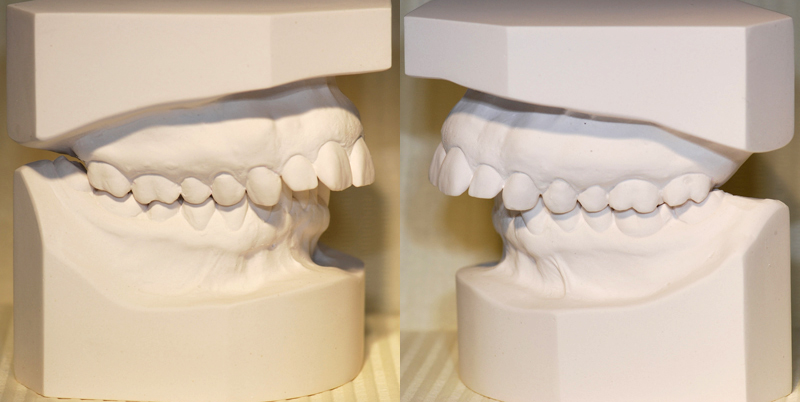 Modèles-études-orthodontiques-orthodontiste-Chamberland-Quebec
