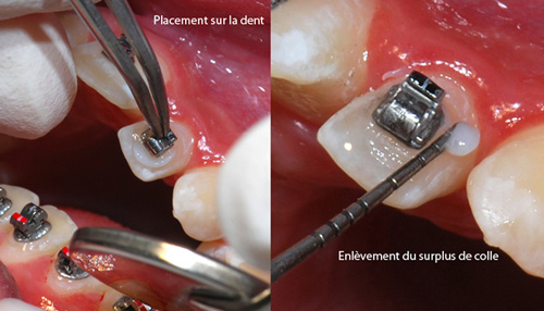 Pose-du-bracket-sur-la-dent-orthodontiste-Chamberland-Québec