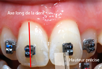 Position-précise-des-brackets-orthodontiste-Chamberland-Québec