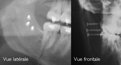Vis-bicorticale-pour-OSMB-Orthodontiste-Chamberland-Quebec