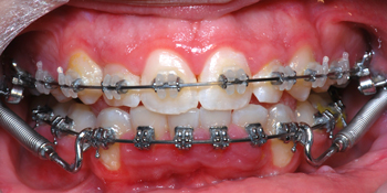 Clarity-SL-et-SmartClip-iof-18-09-09-Orthodontiste-Chamberland-QUébec