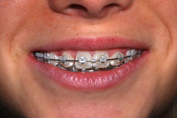 Sourire-InOvation-C-RoLa-orthodontiste-Chamberland-Québec