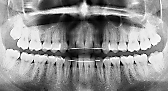 Vue-panoramique-classe-I-parallelisme-radiculaire-orthodontiste-Chamberland-Quebec