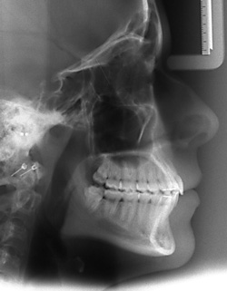 profil-cephalometrique-classe-I-normal-orthodontiste-Chamberland-Quebec