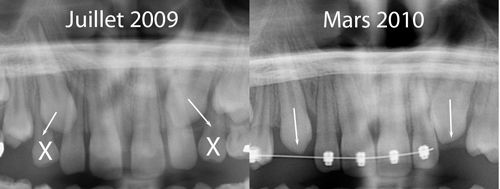 Autocorrection-des-canines-permanentes-orthodontiste-chamberland-québec