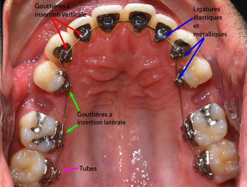 Bracket-Incognito-DaBi-occh-31-01-2011-Orthodontiste-Chamberland-Québec