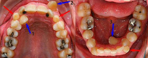 Canine-ectopique-Orthodontiste-Chamberland-Québec