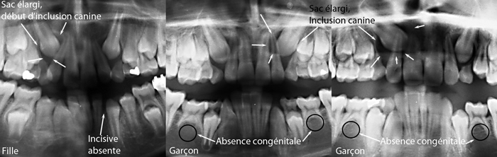 Canine-incluse-et-autres-anomalies-d'éruptions-Orthodontiste-Chamberland-Québec