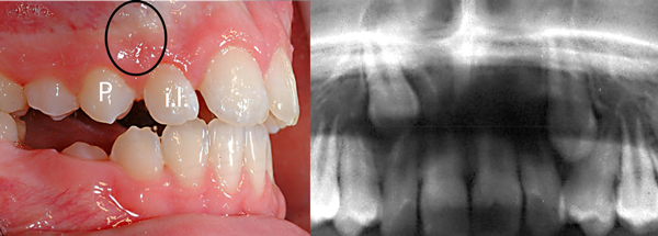 Canine-incluse-manque-d'espace-Orthodontiste-Chamberland-Québec