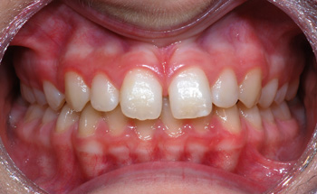 http://www.sylvainchamberland.com/wp-content/uploads/2011/02/Classe-I-excès-despace-diastème-interincisif-orthodontiste-Chamberland-Québec-CuP-iof-initial-170609.jpg