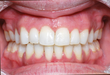 http://www.sylvainchamberland.com/wp-content/uploads/2011/02/Classe-I-protrusion-dentoalvéolaire-bimaxillaire-traité-avec-exo-de-4-prémolaires-BrM-iof-final-03082010-Orthodontiste-Chamberland-Québec.jpg
