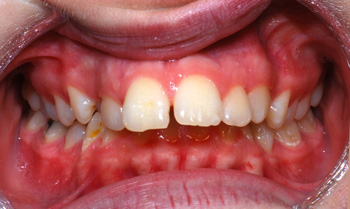http://www.sylvainchamberland.com/wp-content/uploads/2011/02/Classe-II-division-1_canine-incluse-SaC-iof-initial-250208-Orthodontiste-Chamberland-Québec.jpg