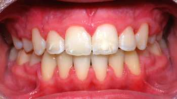 http://www.sylvainchamberland.com/wp-content/uploads/2011/02/Classe-I_manque-despace-grave_disharmonie-dentomaxillaire-LaM-iof-final-130910-Orthodontiste-Chamberland-QUébec.jpg