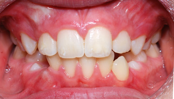 http://www.sylvainchamberland.com/wp-content/uploads/2011/02/Classe-I_manque-despace-grave_disharmonie-dentomaxillaire-LaM-iof-initial-190808-Orthodontiste-Chamberland-QUébec.jpg