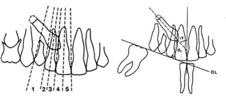 Early-treatment-of-palatally-erupting-maxillary-canine-orthodontiste-Chamberland-QUébec