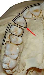 Forme-de-la-canine-orthodontiste-Chamberland-Québec