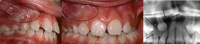Tumeur-à-cellule-géante-canine-incluse-Orthodontiste-Chamberland