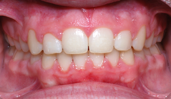 http://www.sylvainchamberland.com/wp-content/uploads/2011/04/Classe-II-div-1-final-GuiMarc-iof-290909Orthodontiste-Chamberland-Quebec.jpg