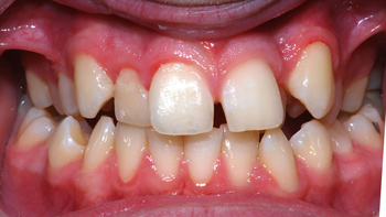 http://www.sylvainchamberland.com/wp-content/uploads/2011/05/Classe-I-articulé-croisé-postérieur-droit-et-antérieur-GuiBea-initial-iof-270409-Orthodontiste-Chamberland-Quebec.jpg