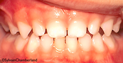 http://www.sylvainchamberland.com/wp-content/uploads/2011/09/Dentition-primaire-espac%C3%A9e-orthodontiste-chamberland-QUebec.jpg