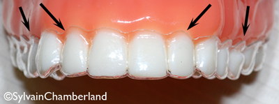 Aligner-sur-l'arcade-superieure-orthodontiste-Chamberland-Quebec