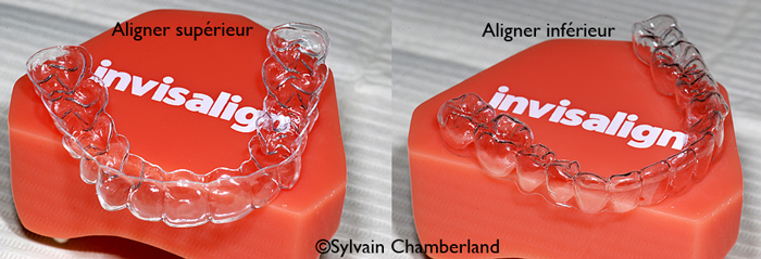Aligners-superieur-et-inferieur-orthodontiste-Chamberland-Quebec