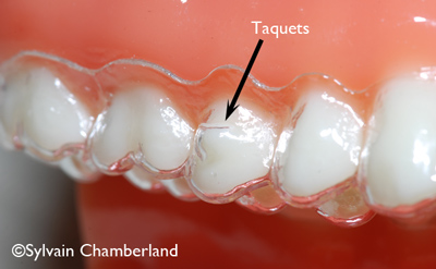 Taquets-d'alignements-orthodontiste-Chamberland-Quebec