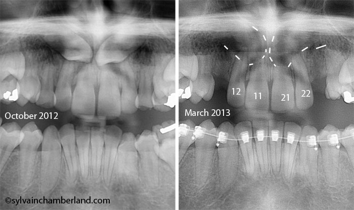 JaSa impacted canine and root resorption-Dr Chamberland orthodontist in Quebec City