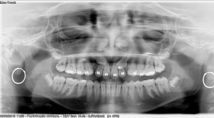 Lor Lac impacted canines-Dr Chamberland orthodontist in Quebec City