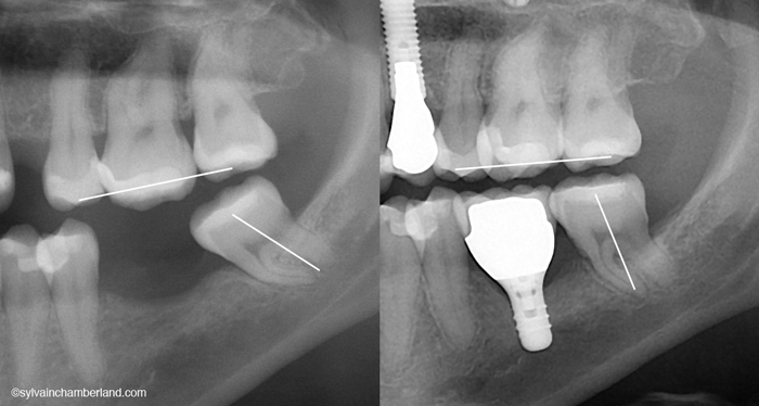 Restauration implantoportée de la dent #36. Redressement de la dent #38 et intrusion de la #26.-Dr Chamberland orthodontiste à Québec