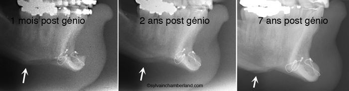 Coche-sous-mandibulaire-apres-genioplastie