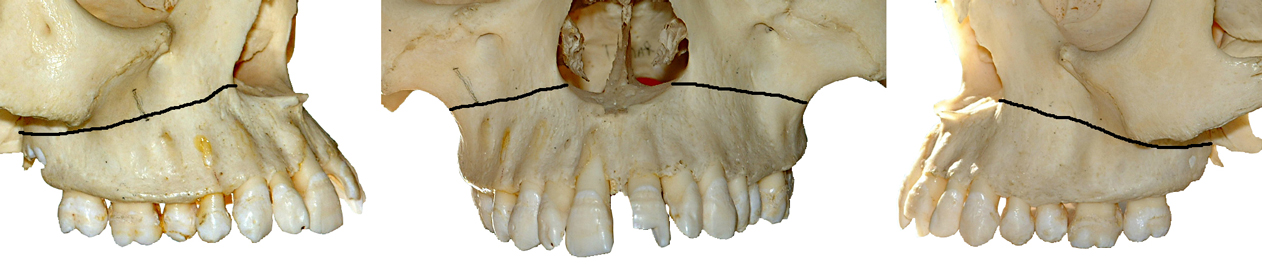 lefort osteotomies
