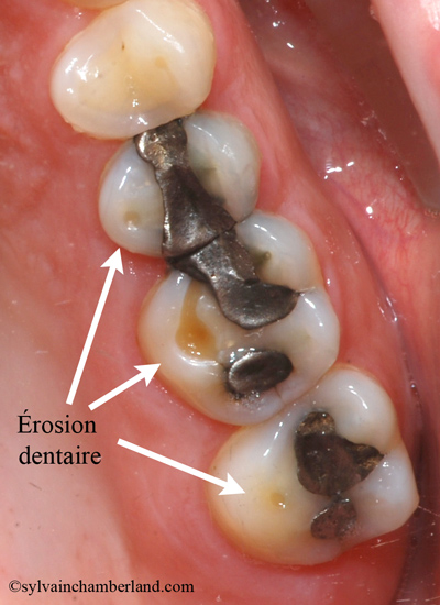 Erosion-dentaire_reflux-gastrique_orthodontiste-Chamberland-Quebec