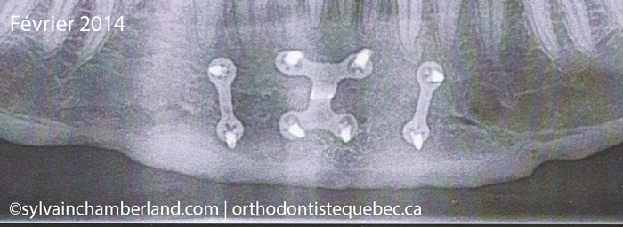 Guerison-genio-de-Sandra-Ti-Chamberland-Orthodontiste-a-Quebec
