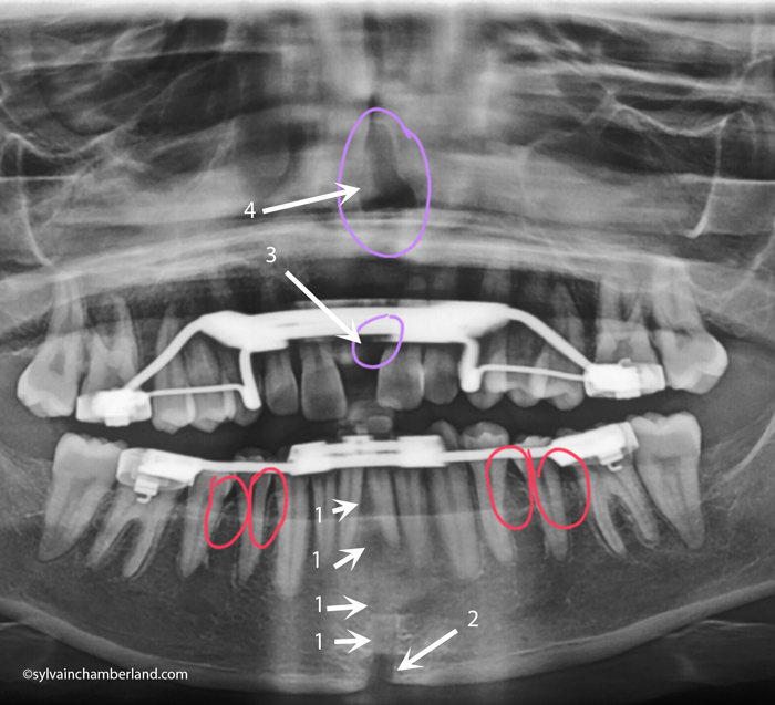 Guerison-post-chiEPRAC-et-EMRAC-CHamberland-Orthodontiste-a-Quebec-jen-doud