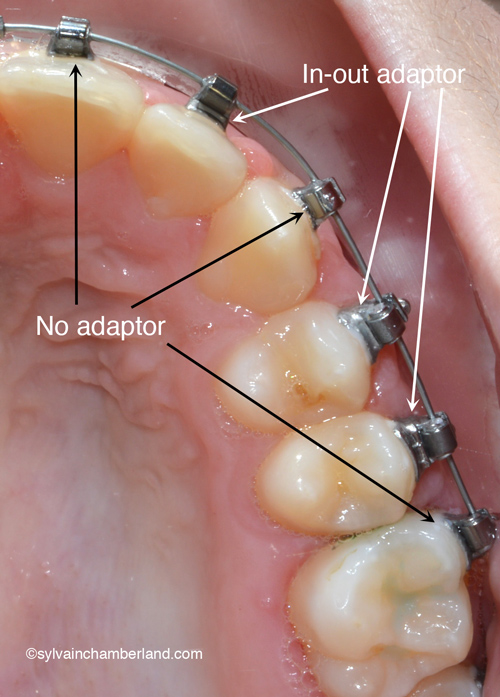 In-out-adaptor-SPEED-bracket-Chamberland-Orthodontiste-a-Quebec