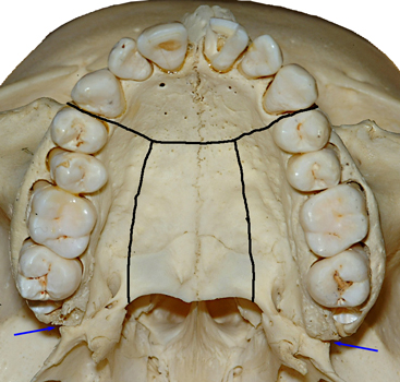 lefort osteotomies