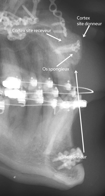 SeCa-Greffe-corticospongieuse-Chamberland-orthodontiste-Quebec