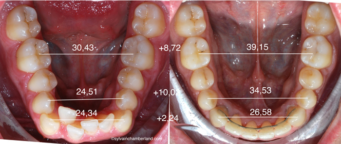 Distraction mandibulaire initial final-Dr Chamberland orthodontiste à Québec