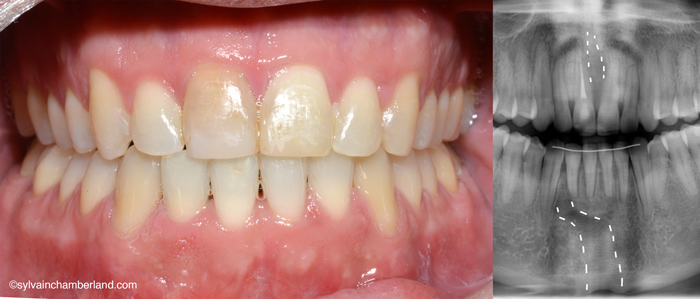 EPRAC distraction symphyse mandibulaire EMRAC-Dr Chamberland orthodontiste à Québec