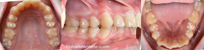 Class II division 1-Dr Chamberland orthodontist in Quebec City
