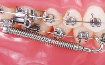 Forsus Class II correctors EZlock-Dr Chamberland orthodontist in Quebec City